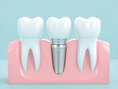 Dental Implant