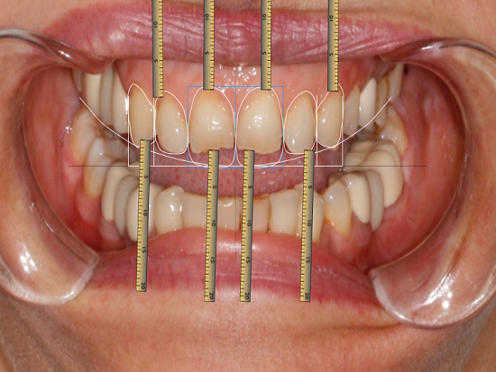 Porcelain Coating for All Teeth