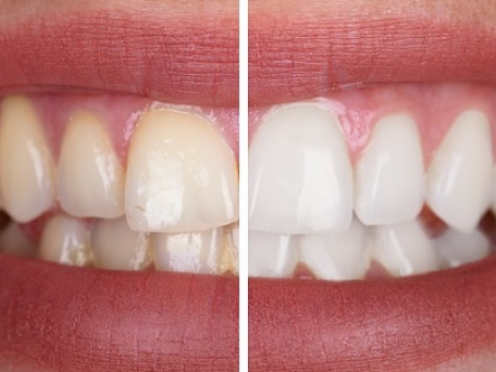 Advantages of Zirconium Crowns: