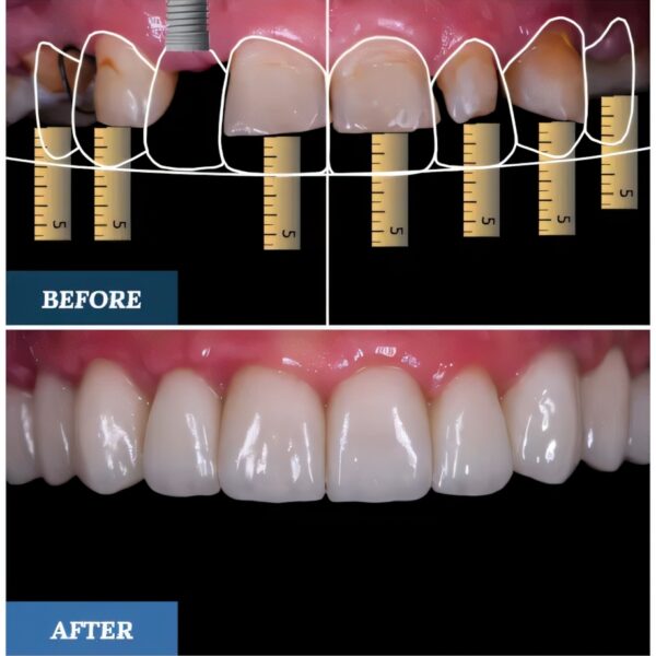 Digital Smile Design Before and After two upscayl 2x ultrasharp