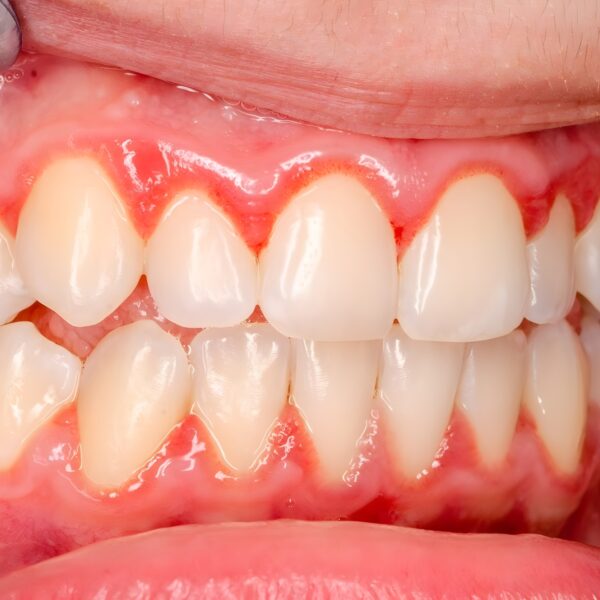 Gingivitis upscayl 2x realesrgan x4plus