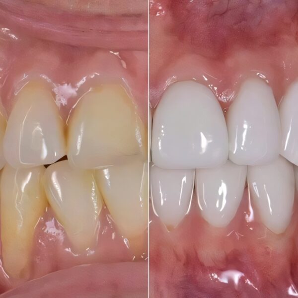 Before after dental crowns patient 09 compressor upscayl 2x ultrasharp