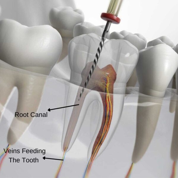 Root treatment